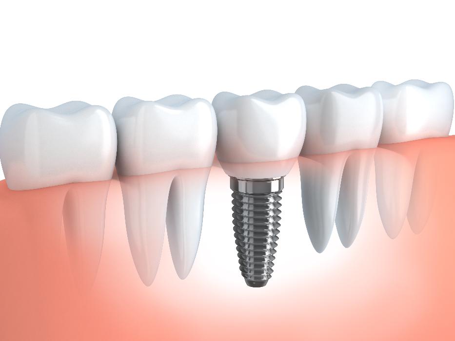 dental implants brentwood tn