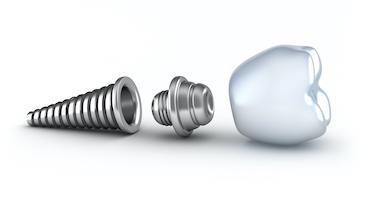 image of a dental implant in brentwood tn