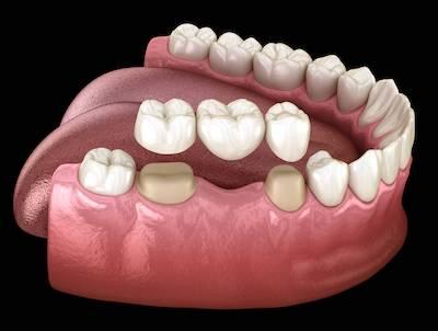 dental bridge brentwood tn