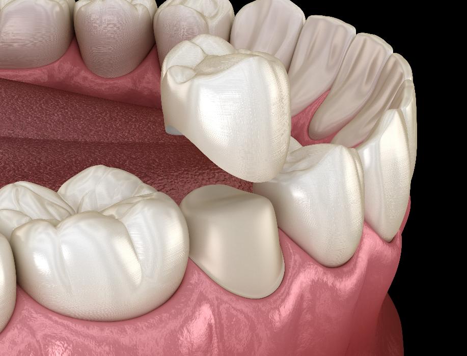 dental crown on tooth | dental crowns brentwood tn