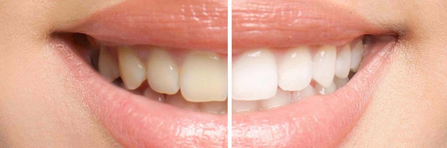 Before and after teeth whitening results at Haley Schmitt, DDS in Brentwood TN