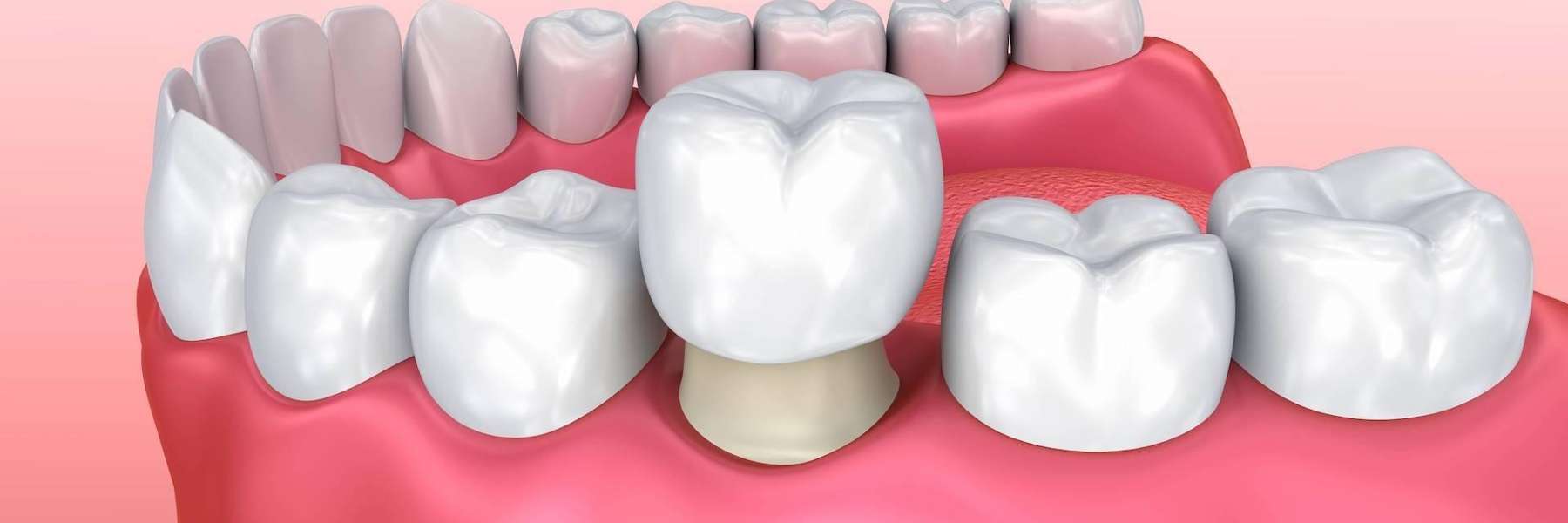 image of a dental crown in Brentwood tn