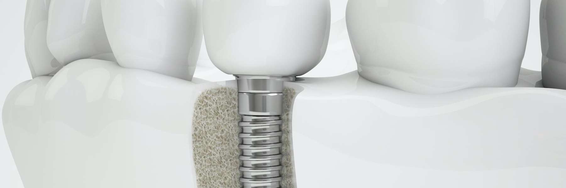 dental implants brentwood