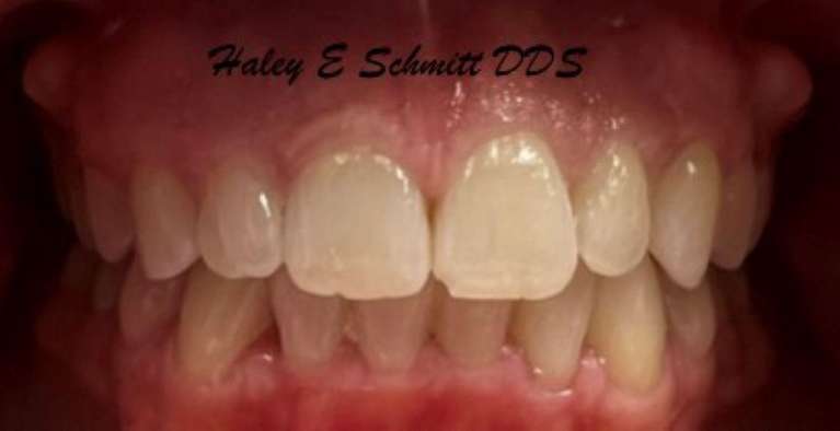 Creating-Straight-Smiles-with-Invisalign-After-Image