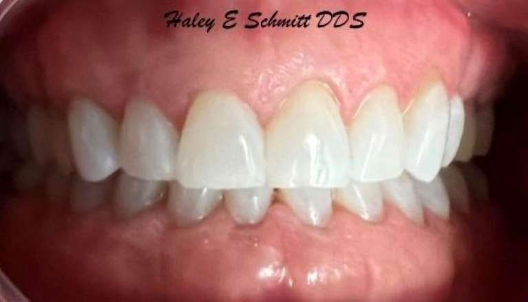 Teeth Whitening