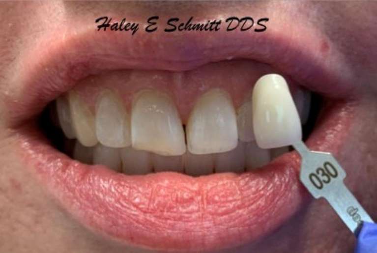 Teeth Whitening