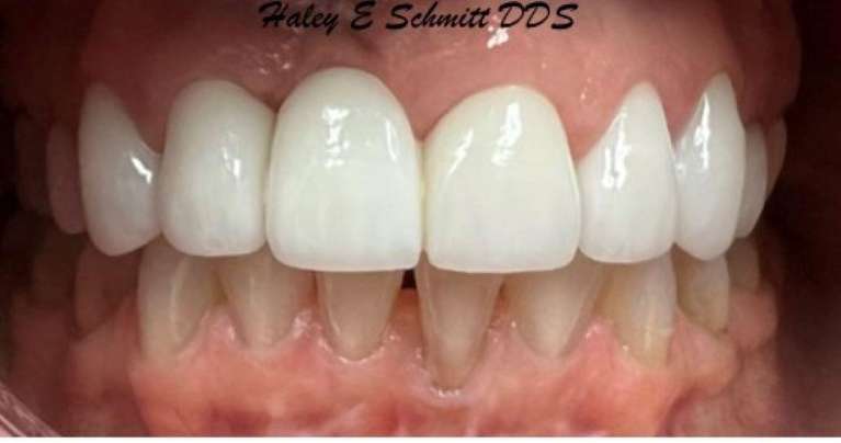 Replacing-Dental-Crowns-and-Bridges-After-Image