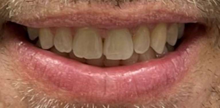 Invisalign-for-the-Win-After-Image
