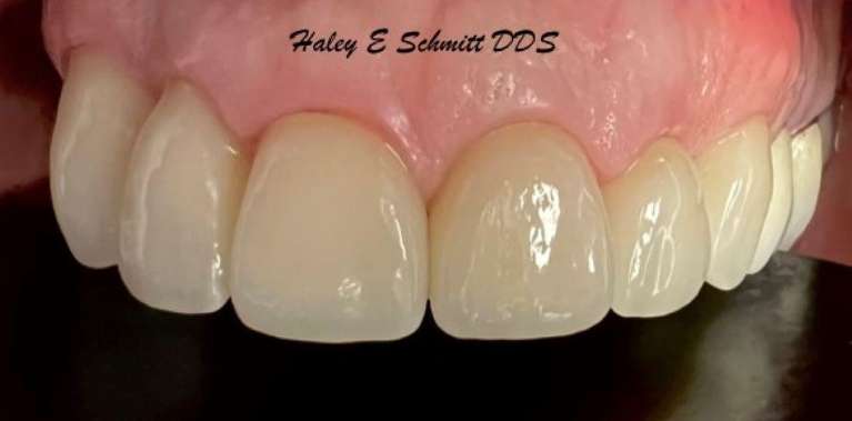 Dental-Crowns-for-Natural-Smiles-After-Image