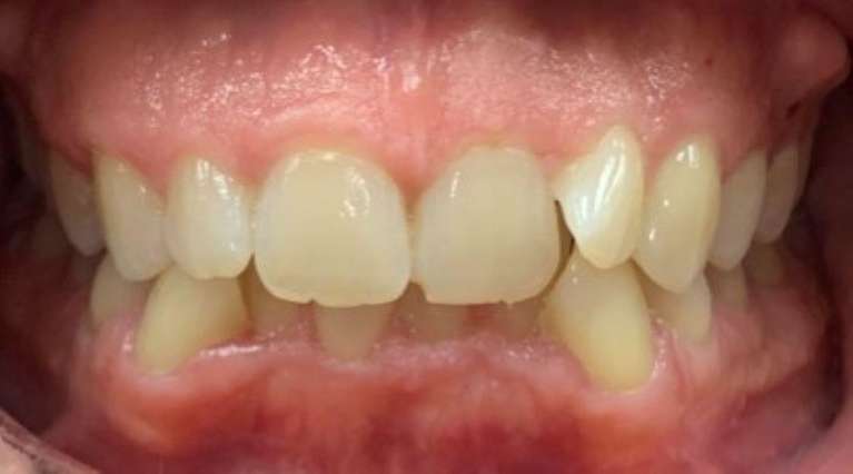 Creating-Straight-Smiles-with-Invisalign-Before-Image