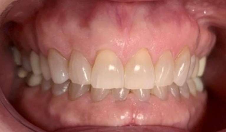 Teeth Whitening