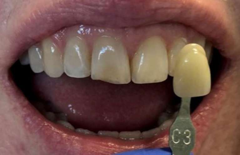 Teeth Whitening