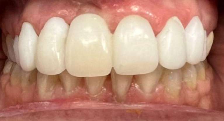 Replacing-Dental-Crowns-and-Bridges-Before-Image