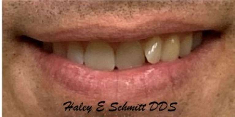 Invisalign-for-the-Win-Before-Image