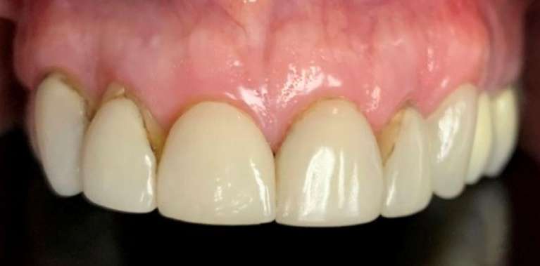 Dental-Crowns-for-Natural-Smiles-Before-Image